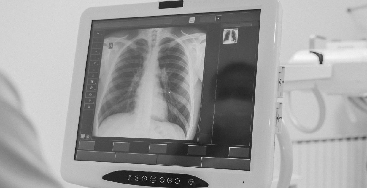 A chest X Ray on a screen